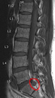 Sagittal MRI of Mah spine